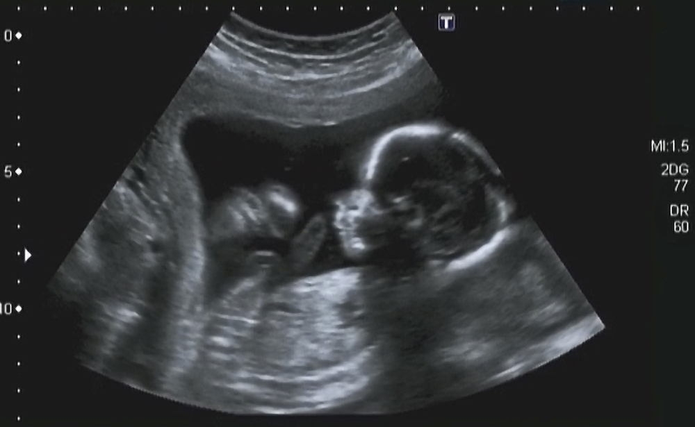 Prenatal Ultrasound: Not So Sound After All