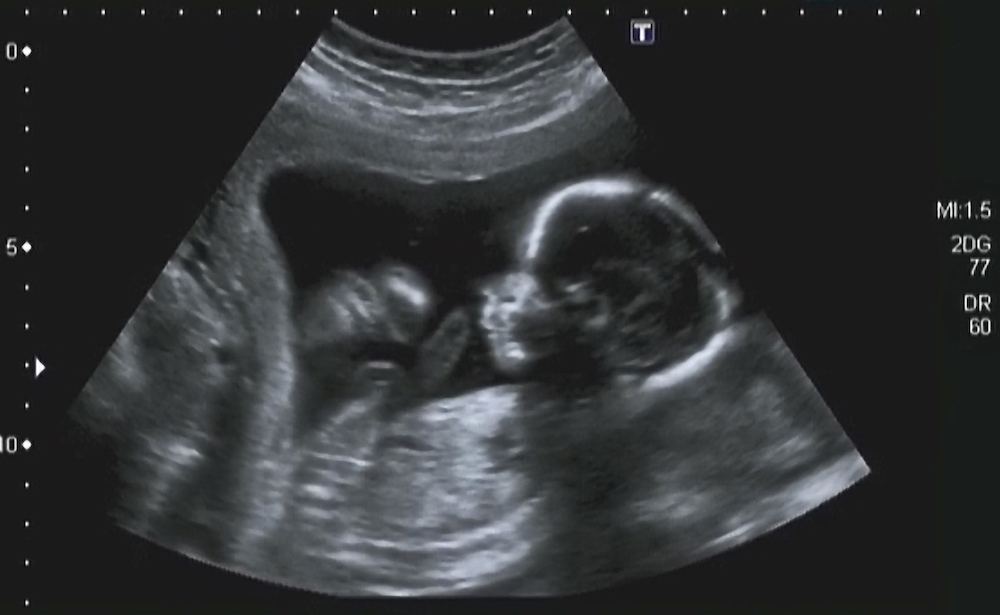 Pregnancy fetal foetus development . Embryonic month stage growth month by month