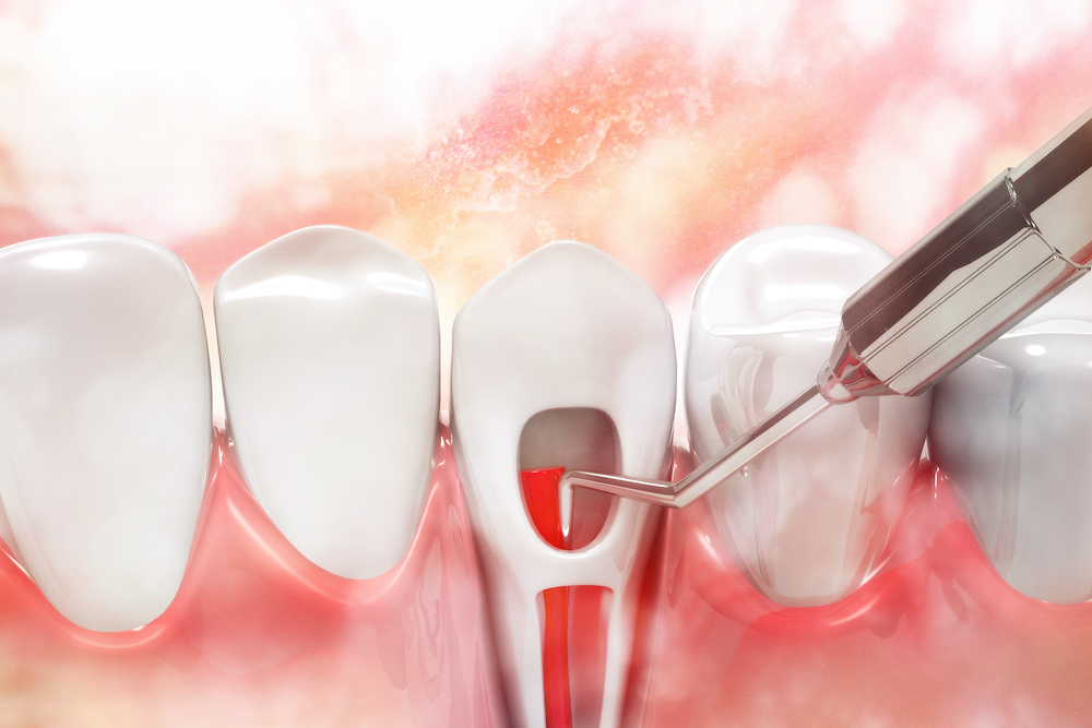 Interview With Dawn Ewing: Should I Get A Root Canal?