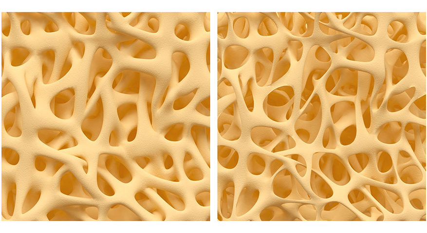 Vitamin A On Trial: Does Vitamin A Cause Osteoporosis?