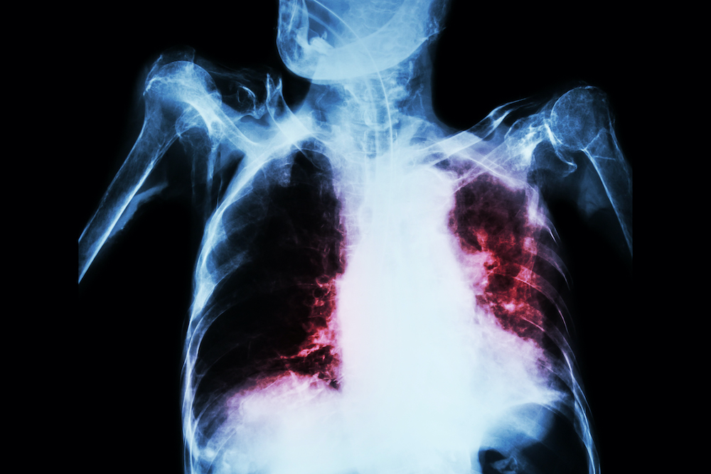 Solving the Mystery of TB: The Iron Factor