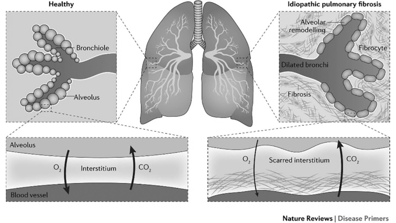 Healing Life and Lungs After Covid