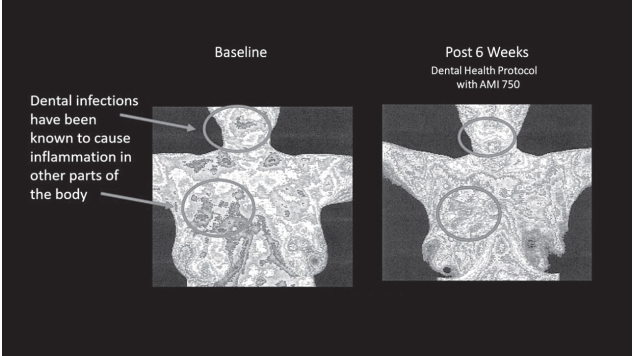 thermographic image of the participant’s front torso revealed the likely source of her health puzzle—her inflamed breast area showed a pathway of inflammation leading from her oral cavity into her breast