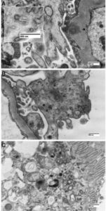 Viral-like particles in non-COVID19 patients’ biopsies. Electron microscopy images of viral-like particles within podocytes in a case of thrombotic microangiopathy in a (A) native kidney biopsy specimen and (B) acute cellular rejection in an allograft. Note the presence in both cases of single vesicles with an electrondense rim likely representing endocytic coated vesicles, as well as larger multivesicular bodies (arrows), which could be confounded with vesicle packets containing virions. Inset in (A): the individual small coated pits in the exterior of the vesicle bear resemblance to a viral corona. (C) Similar intracytoplasmic vesicles within tubules in an allograft with changes suspicious for acute cellular rejection.