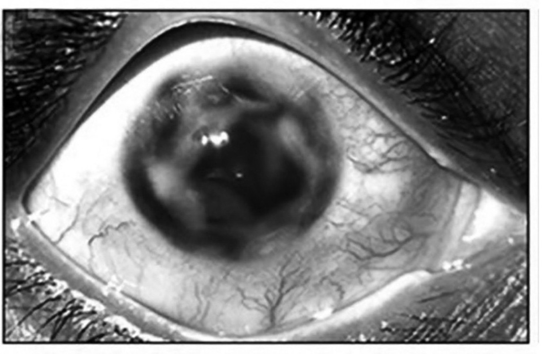 close up of a TB patients exhibit darkening of the eye