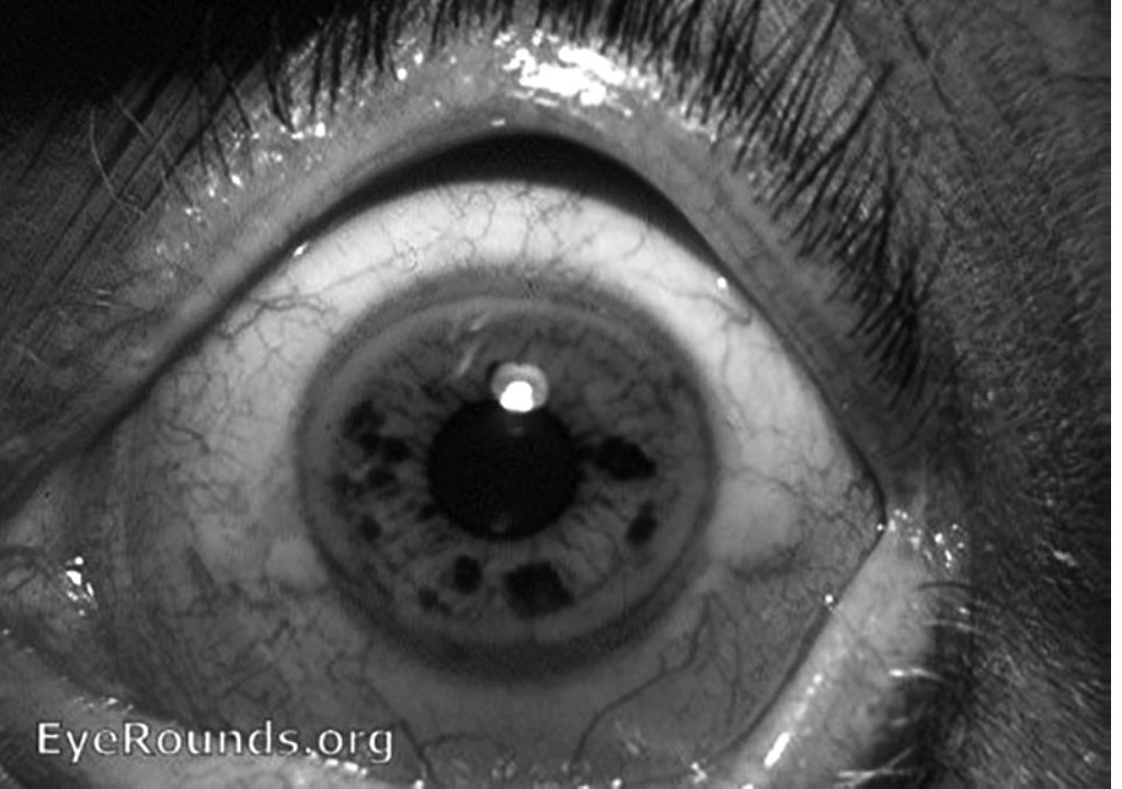 close up of eyeball and darkening of the eye from iron deposits on the retina