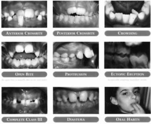 fall09-teethdentalanomalies