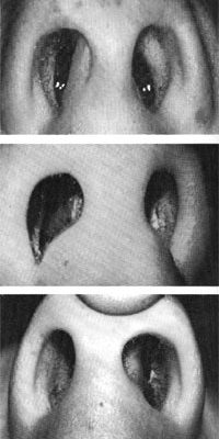 A deviated septum or overgrowth of the soft tissue in the nose can cause blockage of the nostrils, leading to mouth breathing.