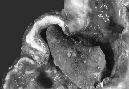 A kidney stone resembling glass embedded in the kidney.