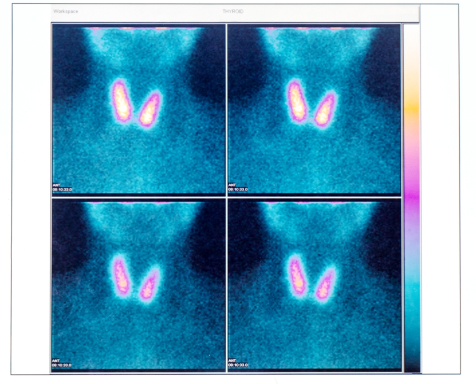 Thyroid help