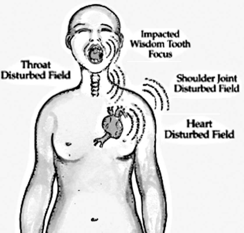 Dental Cavitation Surgery